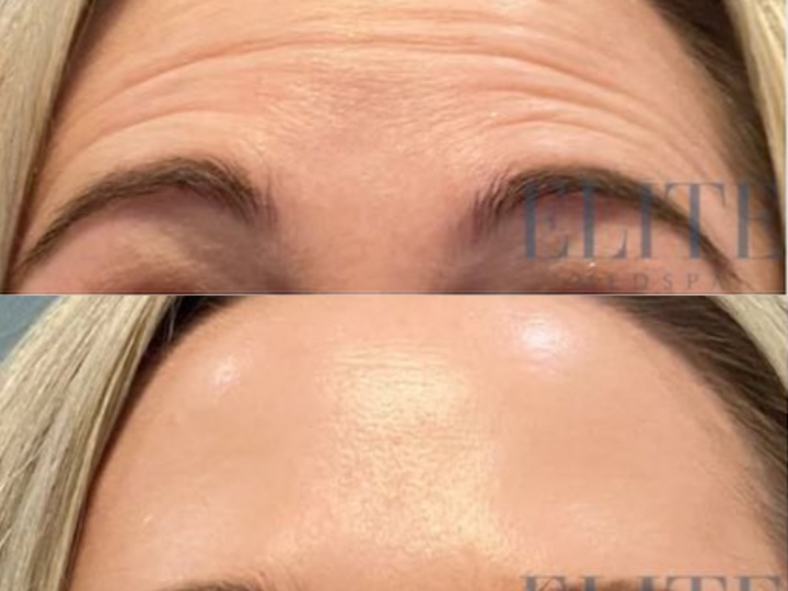 Botox & Dysport treatment at Elite Medspa Scottsdale