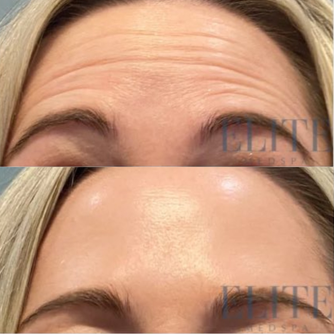 Botox & Dysport treatment at Elite Medspa Scottsdale