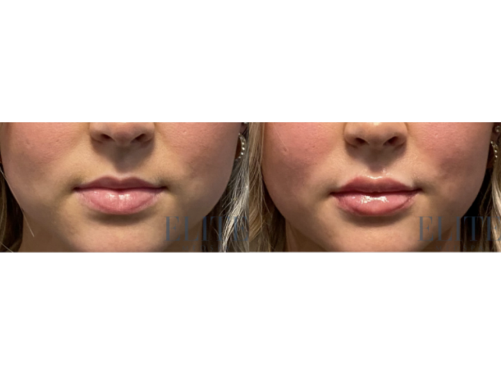 Dermal Fillers treatment at Elite Medspa Scottsdale