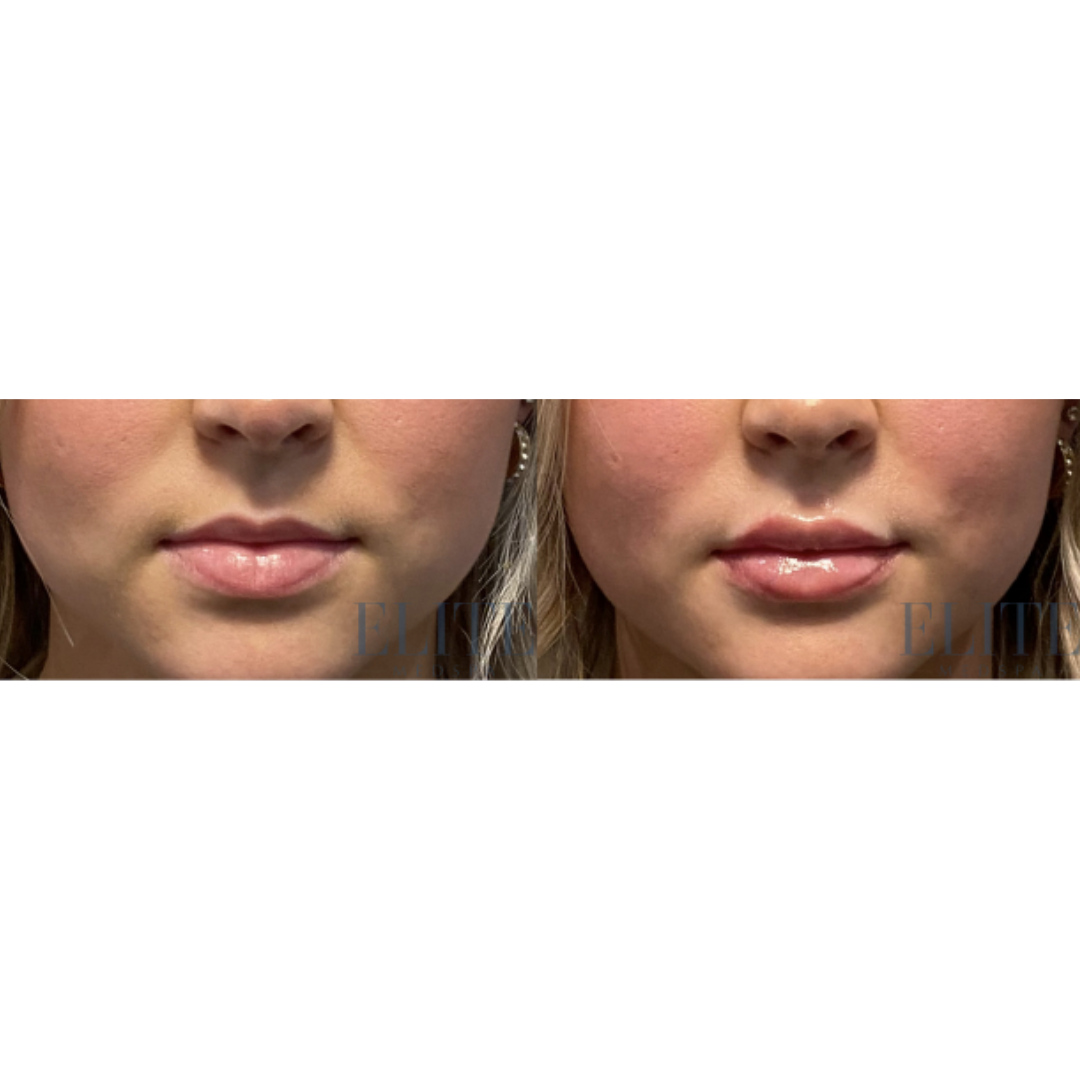 Dermal Fillers treatment at Elite Medspa Scottsdale