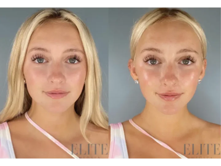 Morpheus8 treatment at Elite Medspa Scottsdale
