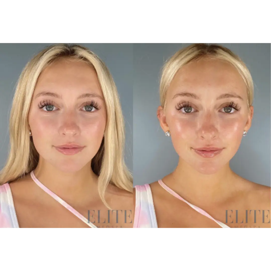 Morpheus8 treatment at Elite Medspa Scottsdale