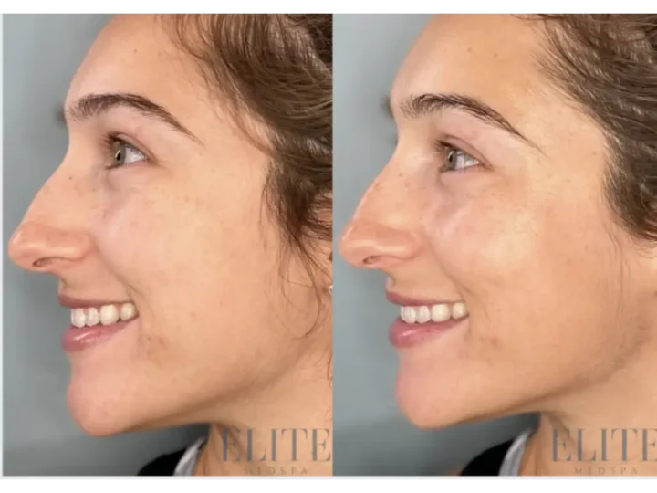 HydraFacial treatment at Elite Medspa Scottsdale