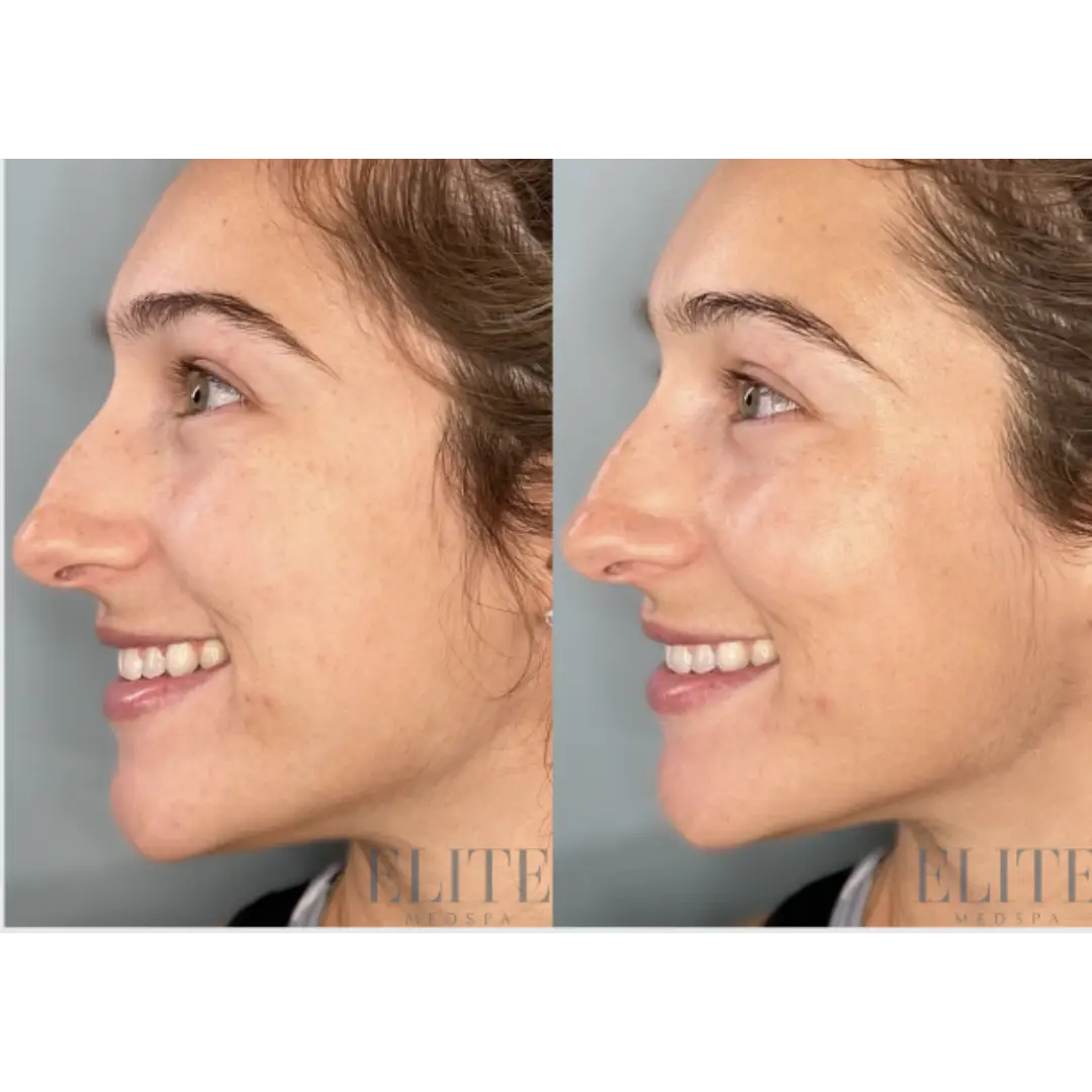 HydraFacial treatment at Elite Medspa Scottsdale