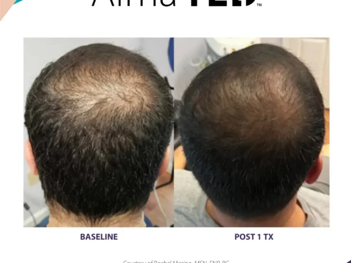 TED Hair Restoration treatment at Elite Medspa Scottsdale
