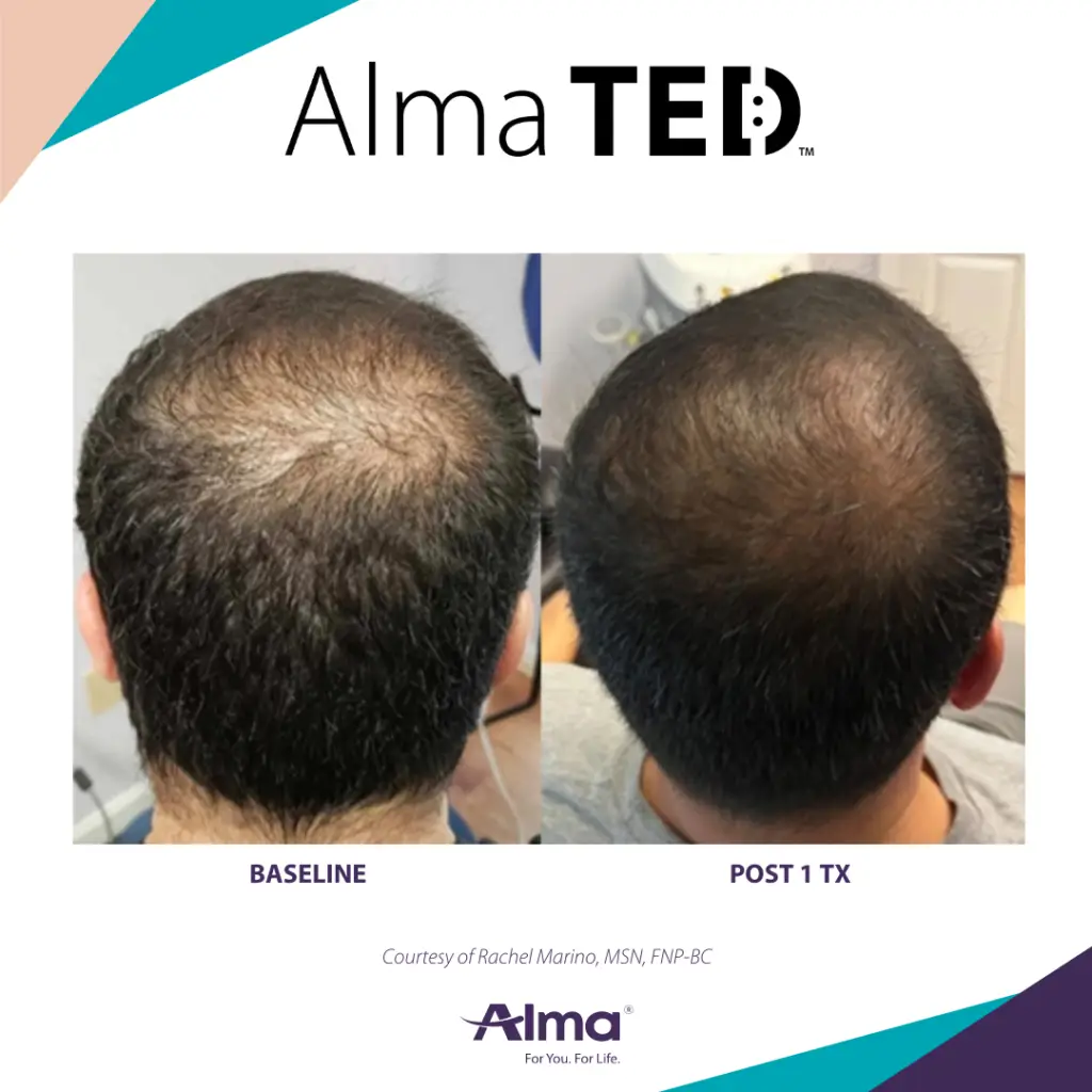 TED Hair Restoration treatment at Elite Medspa Scottsdale