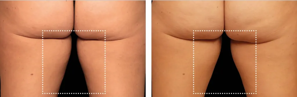 Emsculpt NEO before and after results at Elite Medspa
