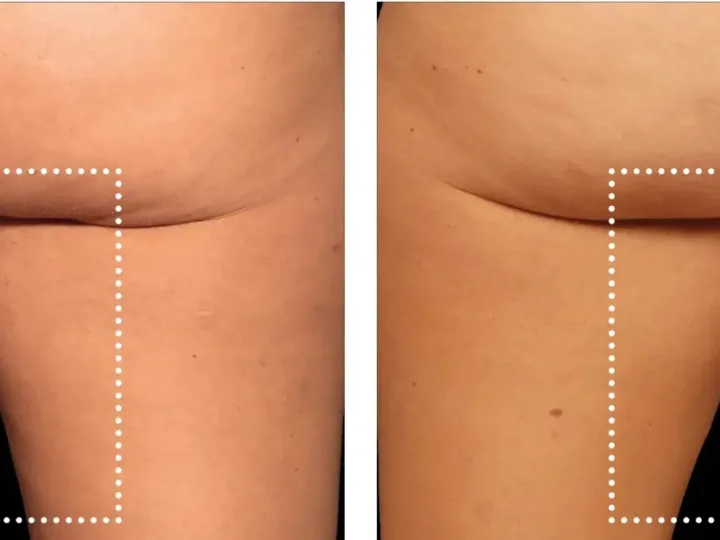 Emsculpt NEO result