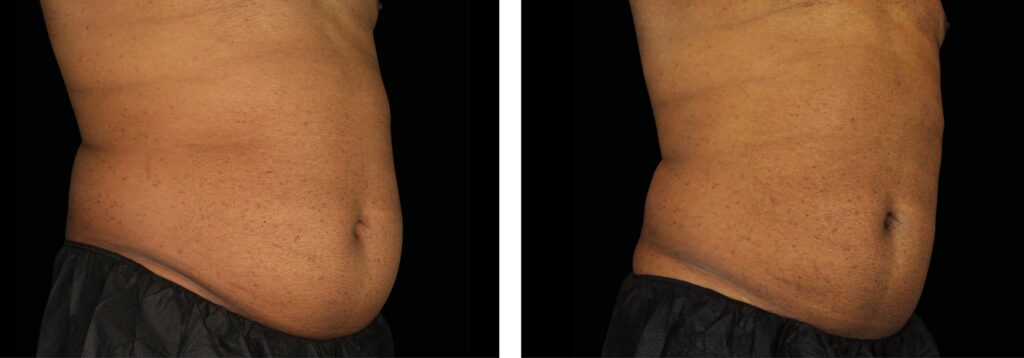 Emsculpt NEO before and after at Elite Medspa