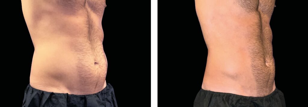 Emsculpt NEO before and after at Elite Medspa