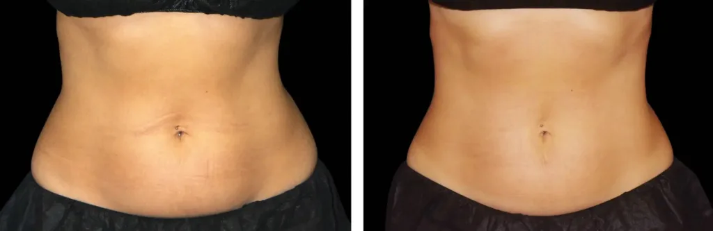 Emsculpt NEO before and after at Elite Medspa