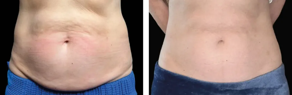 Emsculpt NEO before and after at Elite Medspa