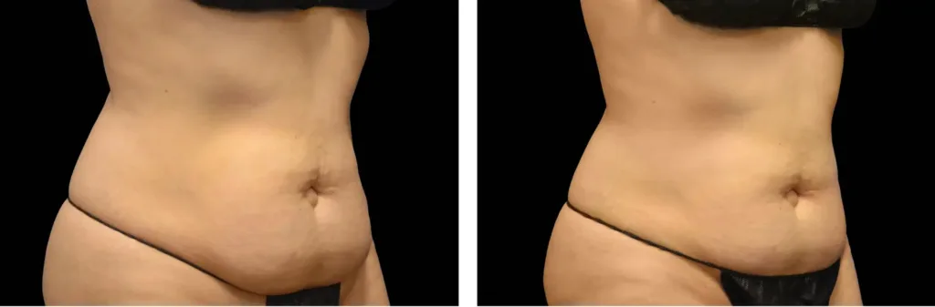 Emsculpt NEO before and after at Elite Medspa