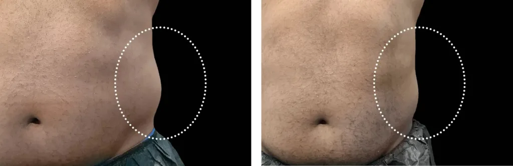 Emsculpt NEO before and after at Elite Medspa
