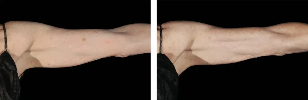 Emsculpt NEO before and after at Elite Medspa
