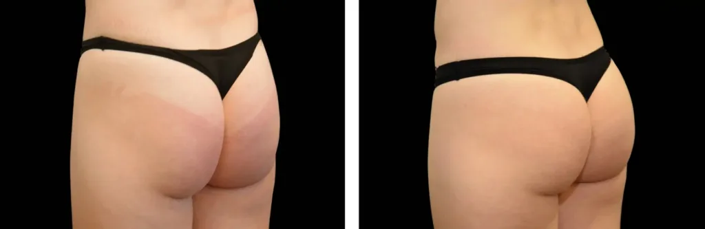 Emsculpt NEO before and after at Elite Medspa