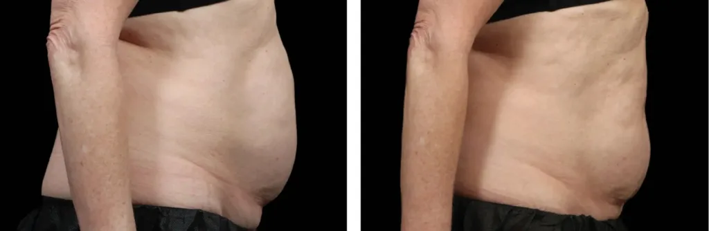Emsella before and after at Elite Medspa