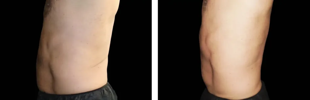 Emsella before and after at Elite Medspa