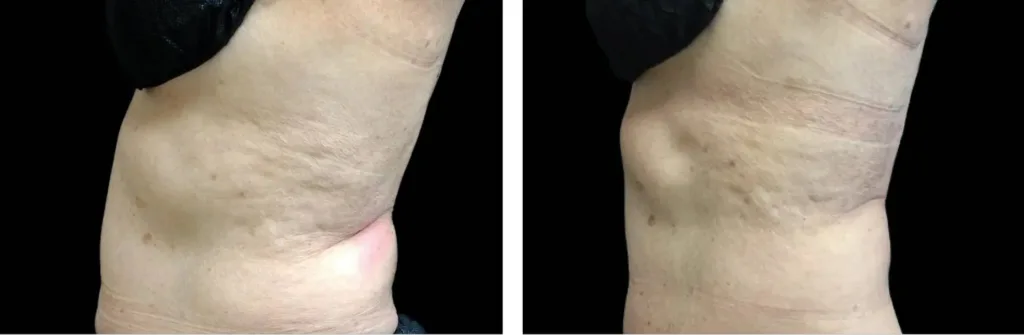 Emsella before and after at Elite Medspa