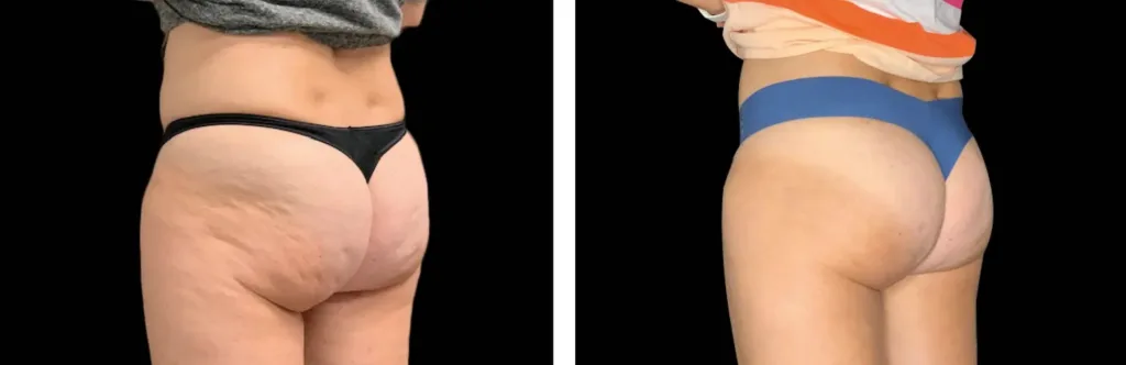 Emtone before and after at Elite Medspa
