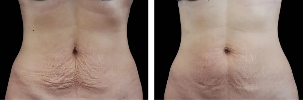 Emtone before and after at Elite Medspa