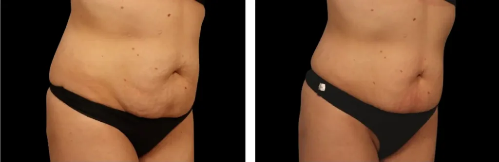 Emtone before and after at Elite Medspa