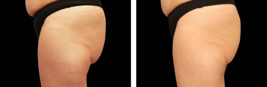 Emtone before and after at Elite Medspa