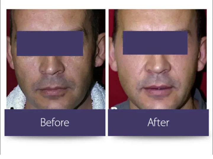 Laser Resurfacing treatment at Elite Medspa Scottsdale