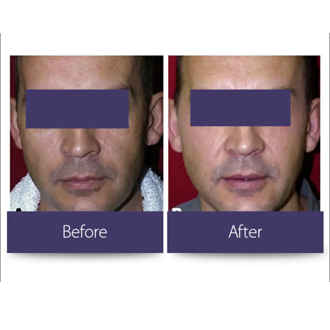Laser Resurfacing treatment at Elite Medspa Scottsdale
