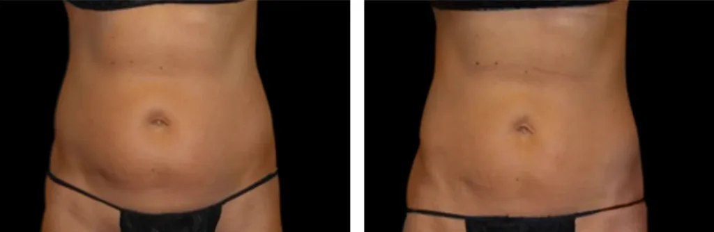 Vanquish before and after at Elite Medspa