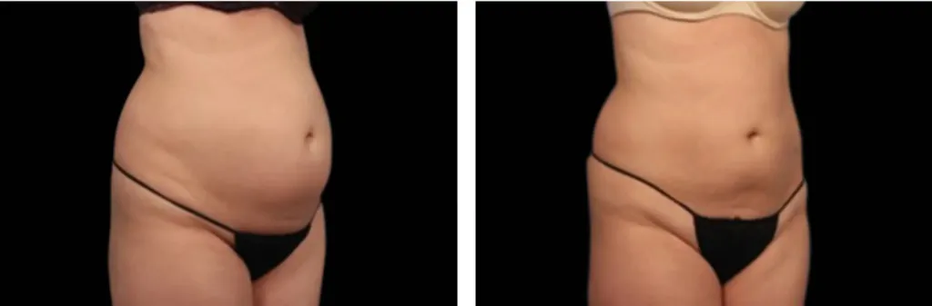 Vanquish before and after at Elite Medspa