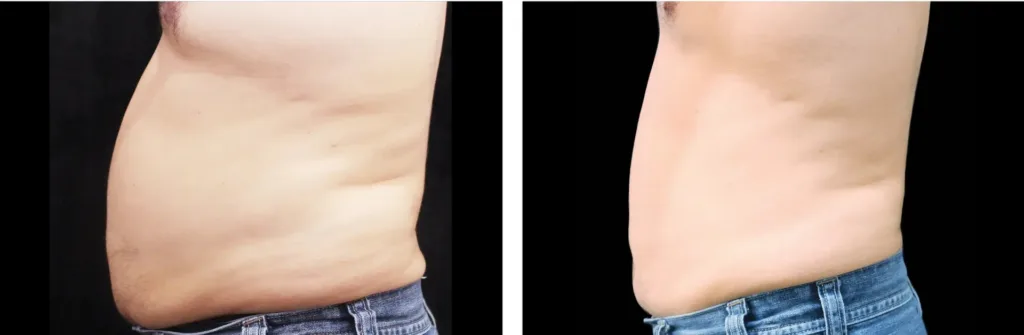 Vanquish before and after at Elite Medspa